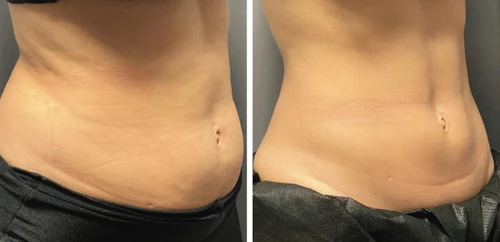 TruSculpt iD