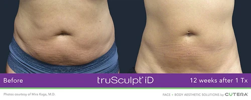 TruSculpt iD