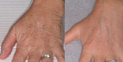 CO2 Laser Hand Resurfacing
