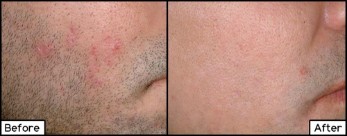Laser Hair Removal