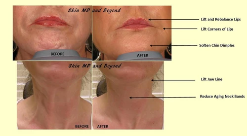 Botox