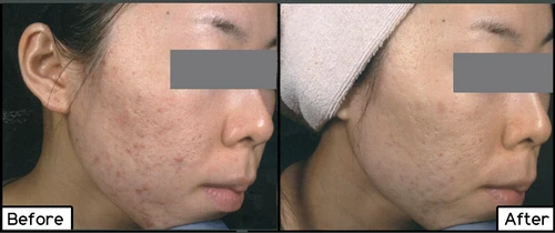 Dermapen
