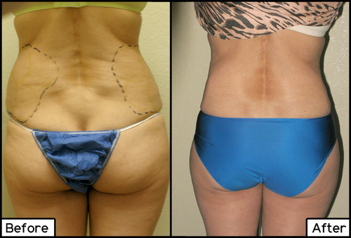 ThermiShape