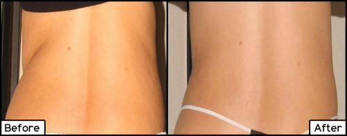 TruSculpt iD