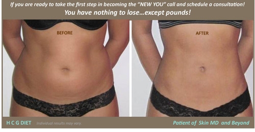 HCG Diet