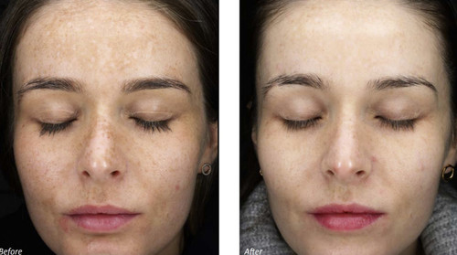 DermaFrac Micro-Needling