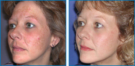 Microdermabrasion
