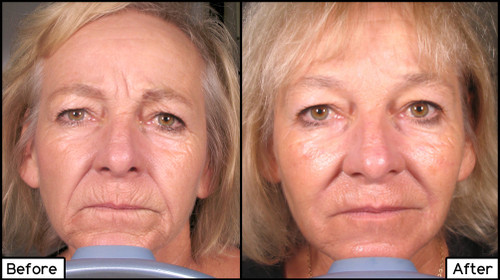 Facial Fillers