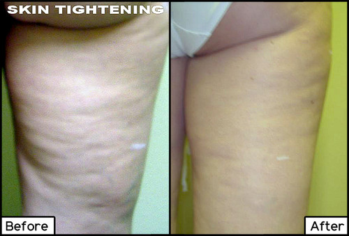Cellulite Treatments