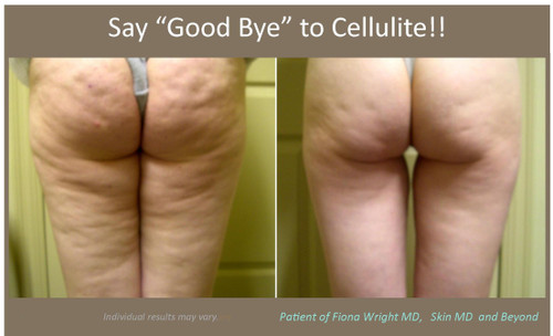 Cellulite Treatments