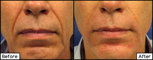 Juvederm Facial Fillers