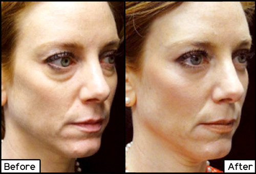 Juvederm Facial Fillers
