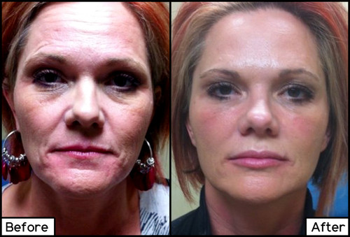 Juvederm Facial Fillers