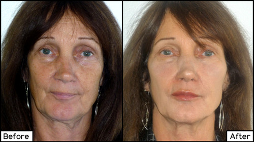 Juvederm Facial Fillers