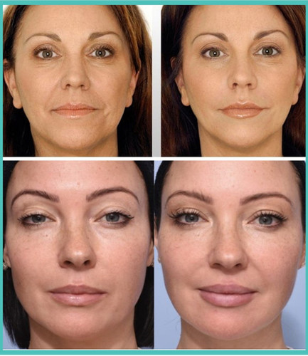Juvederm Facial Fillers