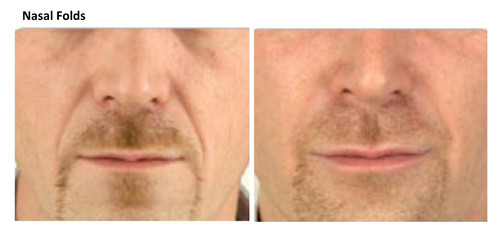 Revance Facial Fillers
