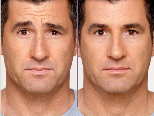 Botox