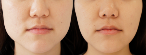 Botox