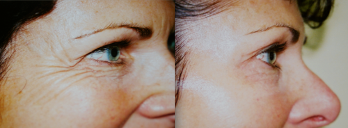 Botox