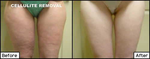 Cellulite Treatments