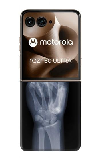 S3101 X-ray Peace Sign Fingers Case For Motorola Razr 70 Ultra, 60 Ultra, 50 Ultra, Ultra 2026, Ultra 2025