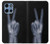 S3101 X-ray Peace Sign Fingers Case For Motorola Moto G 5G (2025)