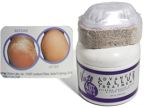 Vite 20 Urea 40% Advanced CALLUS Treatment 4oz Vite 20 Urea 40% Advanced CALLUS Treatment 4oz