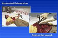 Care of the Evisceration Injury Patient (Disembowelment)