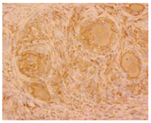 Skin Sarcoidosis (paraffin section) 
Epithelioid cells and multi-nucleated giant cells in granulomas and surrounding macrophages are positive.
 Takeya M., Second Department of Pathology, Kumamoto University 
School of Medicine, Kumamoto, Japan