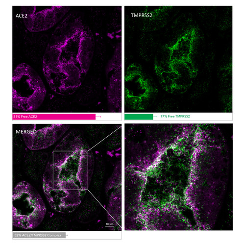 MolBoolean analysis of the interaction between ACE2 (cat. AMAb91259, magenta) and TMPRSS2 (cat. HPA035787, green) in human kidney, showing the relative quantification of free versus interacting protein fractions, indicated by the detection of rolling circle products (RCPs) in either one or two fluorescent channels. Data is normalized to total target protein levels (total RCPs). MolBoolean analysis of the interaction between ACE2 (cat. AMAb91259, magenta) and TMPRSS2 (cat. HPA035787, green) in human kidney, showing the relative quantification of free versus interacting protein fractions, indicated by the detection of rolling circle products (RCPs) in either one or two fluorescent channels. Data is normalized to total target protein levels (total RCPs).