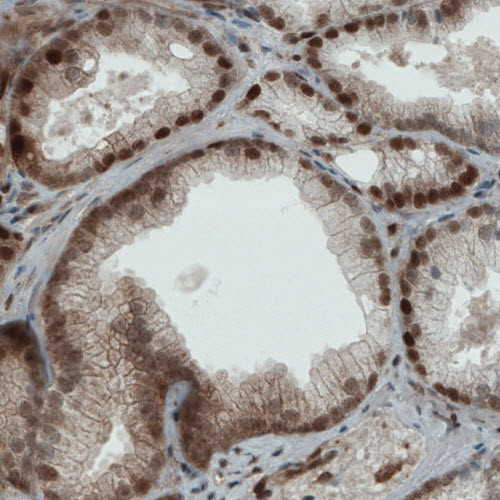 Immunohistochemical staining of human prostate cancer shows strong nuclear and moderate cytoplasmic immunoreactivity in tumor cells.