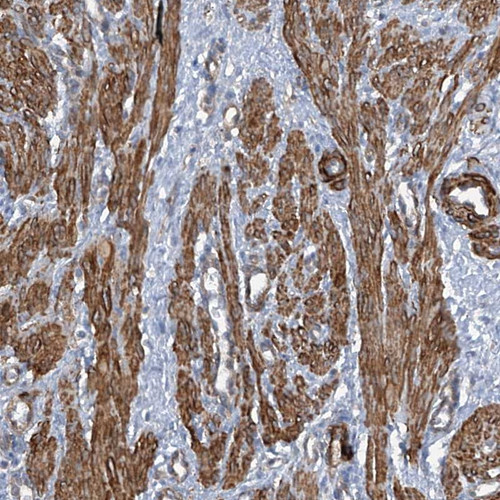 Immunohistochemical staining of human smooth muscle shows strong cytoplasmic positivity in smooth muscle cells.