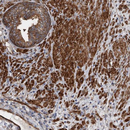 Immunohistochemical staining of human prostate shows strong cytoplasmic positivity in smooth muscle cells.