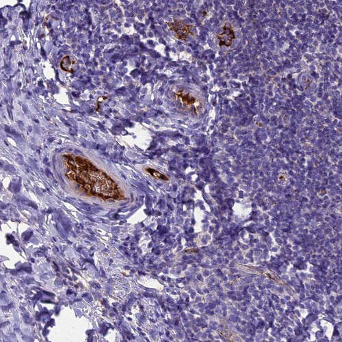 Immunohistochemical staining of human tonsil shows distinct positivity in plasma. Immunohistochemical staining of human tonsil shows distinct positivity in plasma.