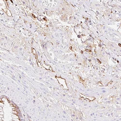 Immunohistochemical staining of human rectum shows distinct cytoplasmic positivity in lymph vessels.