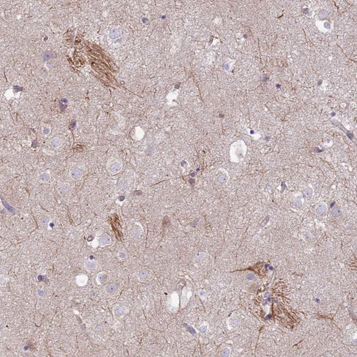 Immunohistochemical staining of human caudate shows cytoplasmic positivity in a subset of glial cells.