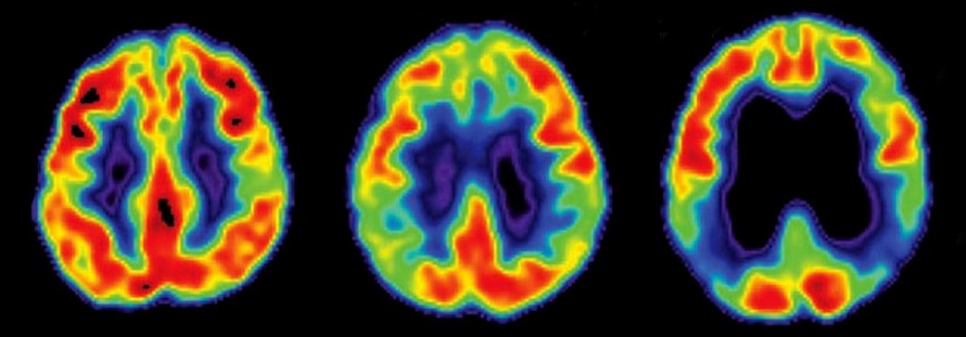 PET image of normal and deteriorating alzheimers brains