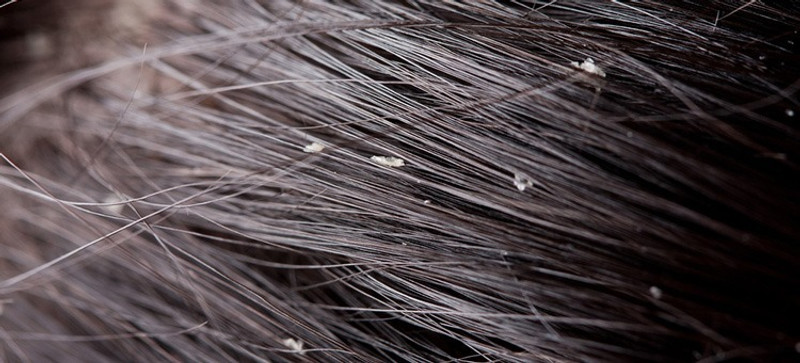 How To Stop Dandruff In Natural Hair Hairobics All Natural