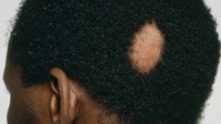 Types of Hair Loss