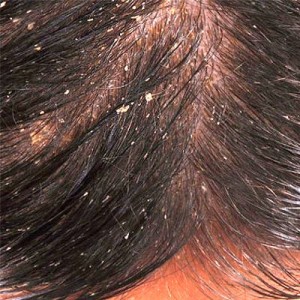 Tips to Treat Dandruff Naturally