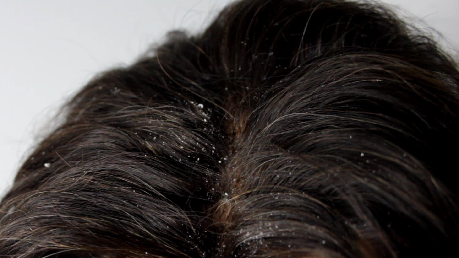 Dandruff Remedies to Get Rid of Dandruff