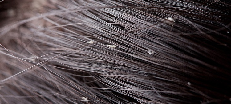 How to Stop Dandruff in Natural Hair