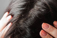  Causes and How to Treat Dandruff