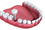 How Long Does it Take for a Tooth Implant to Stop Hurting?