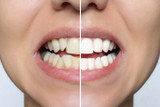 Clip-On Veneers vs. Permanent Veneers 