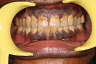 Dental fluorosis