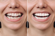 How to Achieve a Hollywood Smile