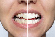 Clip-On Veneers vs. Permanent Veneers 