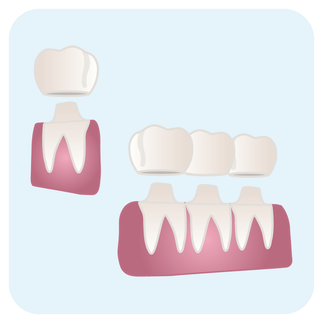 instasmile is an alternative to dental crowns or bridges