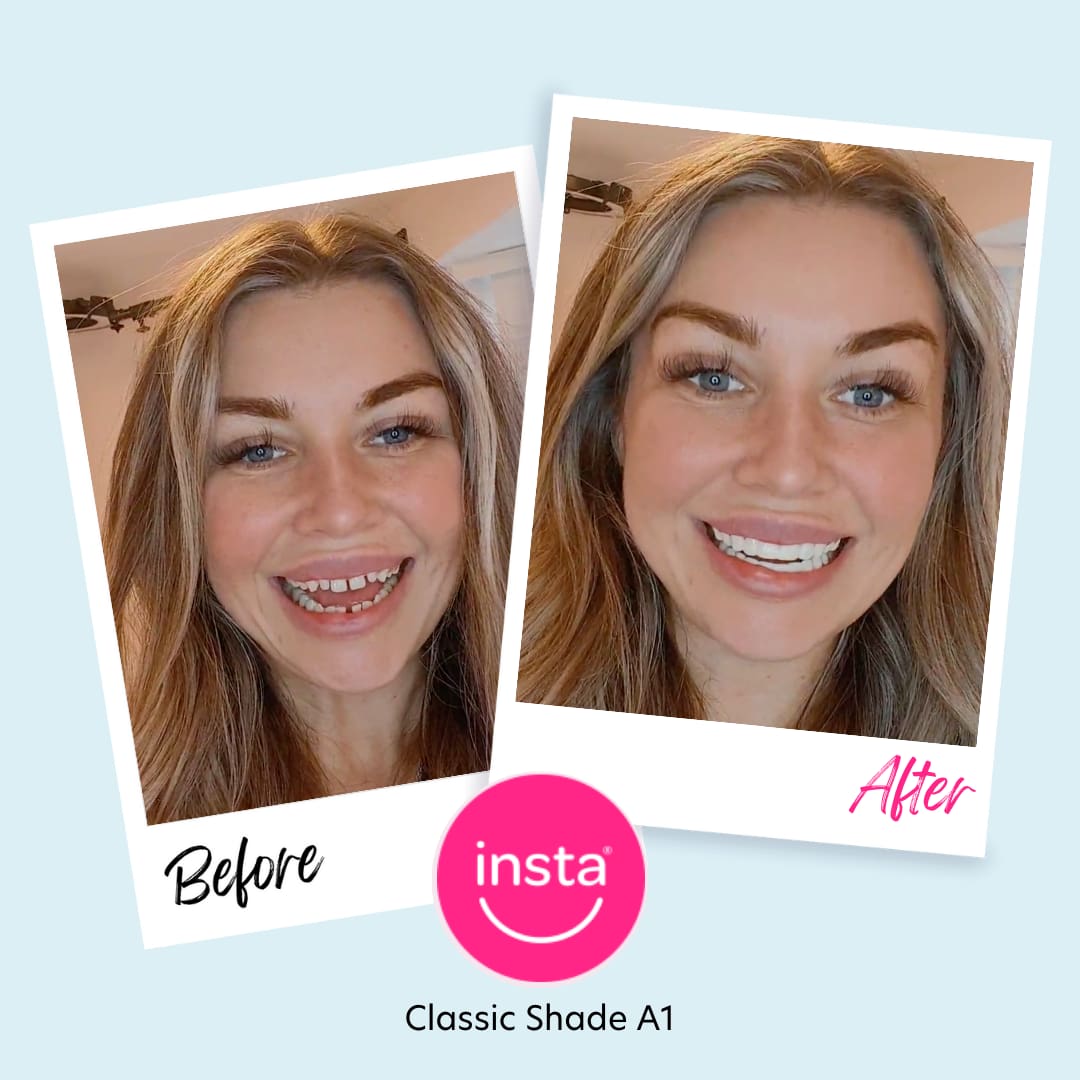 Instasmile Classic Veneers